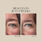 Before and after image showing fewer visible wrinkles in the eye area with text Results in just 8 weeks.